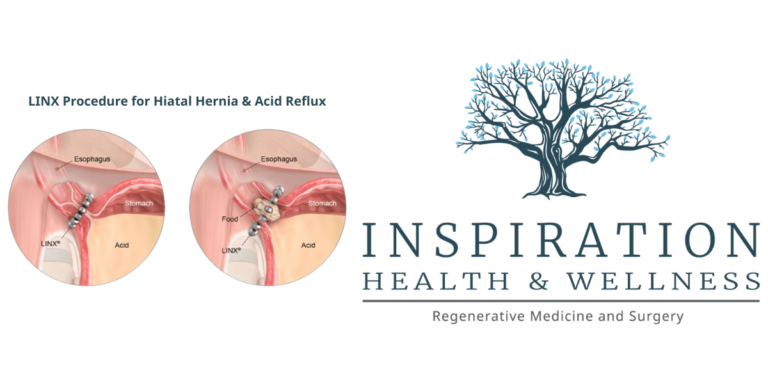 LINX procedure for Hiatal Hernia & Acid Reflux